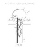 VASCULAR REMODELING DEVICE diagram and image