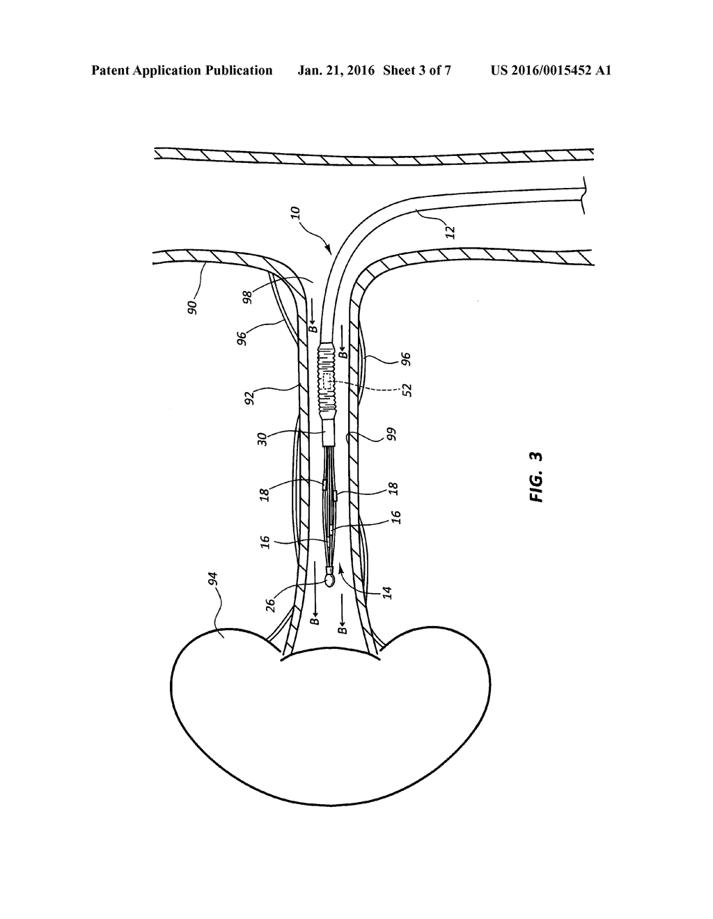 FEEDBACK SYSTEMS AND METHODS FOR RENAL DENERVATION UTILIZING BALLOON     CATHETER - diagram, schematic, and image 04