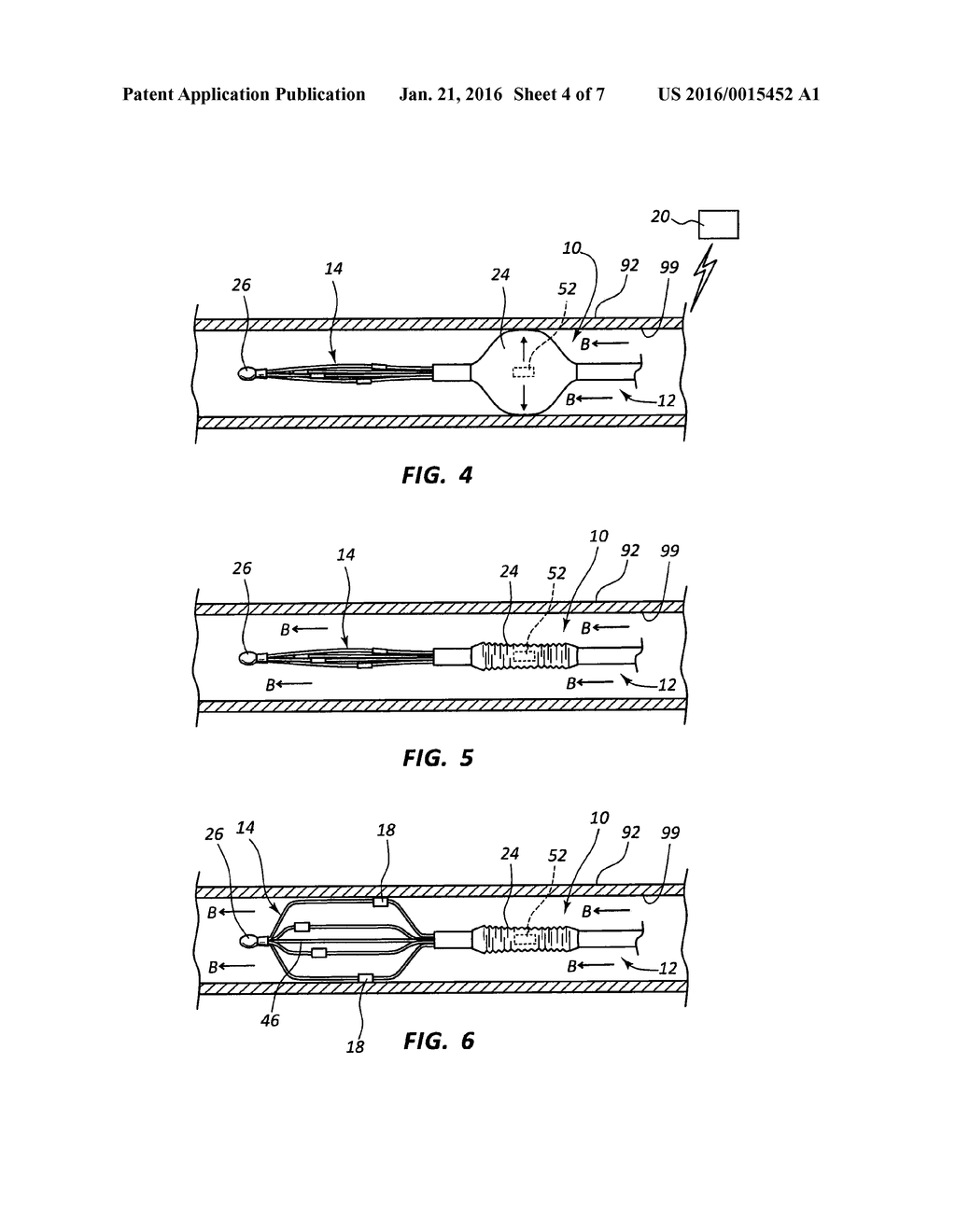 FEEDBACK SYSTEMS AND METHODS FOR RENAL DENERVATION UTILIZING BALLOON     CATHETER - diagram, schematic, and image 05