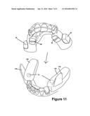 Cuspid and First Bi-Cuspid Bite Retainer for Sleep Apnea diagram and image