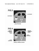 REGION EXTRACTION APPARATUS, METHOD, AND PROGRAM diagram and image