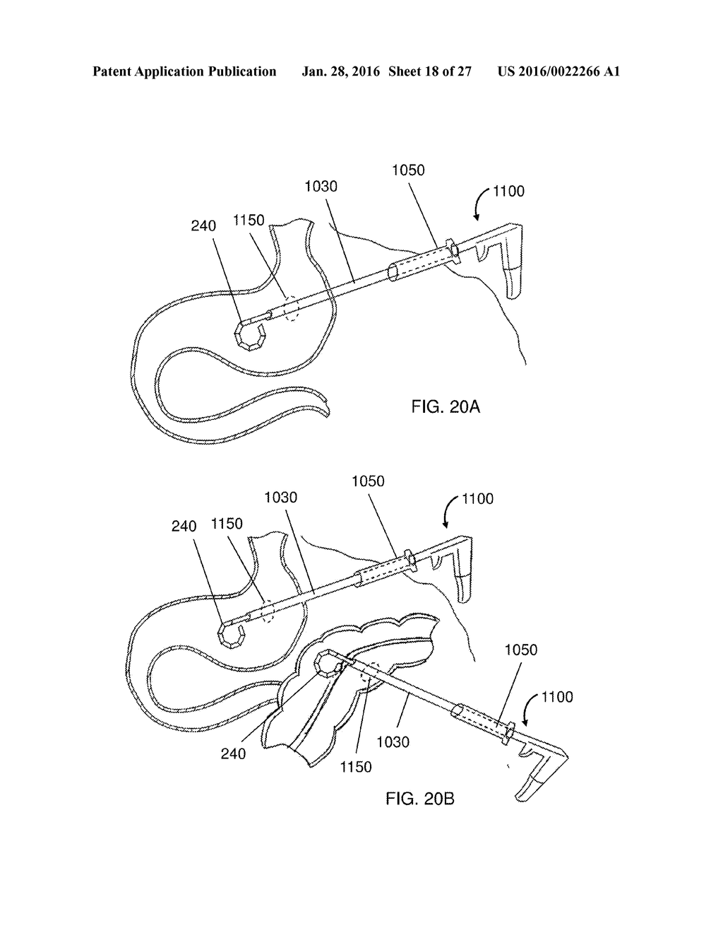 MAGNETIC ANASTOMOSIS DEVICES AND METHODS OF DELIVERY - diagram, schematic, and image 19