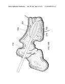 SYSTEMS AND METHODS FOR TREATING CONDITIONS AND DISEASES OF THE SPINE diagram and image