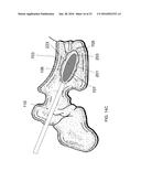 SYSTEMS AND METHODS FOR TREATING CONDITIONS AND DISEASES OF THE SPINE diagram and image