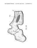 SYSTEMS AND METHODS FOR TREATING CONDITIONS AND DISEASES OF THE SPINE diagram and image