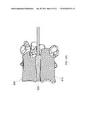 SYSTEMS AND METHODS FOR TREATING CONDITIONS AND DISEASES OF THE SPINE diagram and image