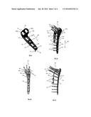 Apparatus for Humeral Fracture Repair diagram and image