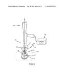 LARGE VOLUME TISSUE REDUCTION AND REMOVAL SYSTEM AND METHOD diagram and image