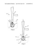 LARGE VOLUME TISSUE REDUCTION AND REMOVAL SYSTEM AND METHOD diagram and image