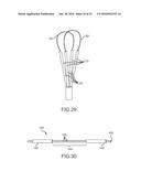 LARGE VOLUME TISSUE REDUCTION AND REMOVAL SYSTEM AND METHOD diagram and image