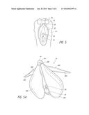 SYSTEMS AND METHODS FOR TREATING FEMALE INCONTINENCE AND PELVIC NERVE     DYSFUNCTION diagram and image