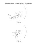 SYSTEMS AND METHODS FOR TREATING FEMALE INCONTINENCE AND PELVIC NERVE     DYSFUNCTION diagram and image