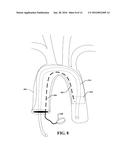 ENDOVASCULAR PERFUSION STENT GRAFT diagram and image
