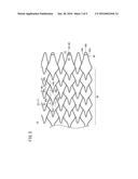 STENT diagram and image