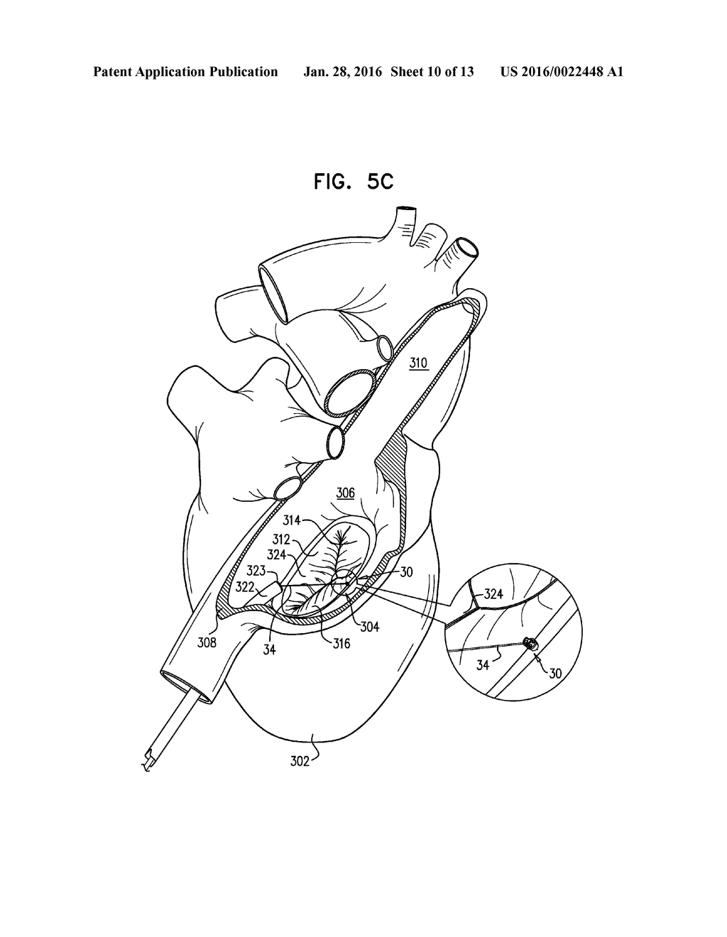 STENT WITH TETHER INTERFACE - diagram, schematic, and image 11