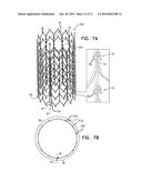 STENT WITH TETHER INTERFACE diagram and image