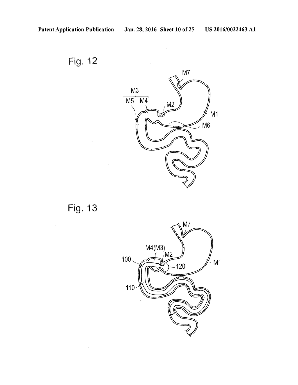 DIGESTIVE TRACT DEVICE - diagram, schematic, and image 11