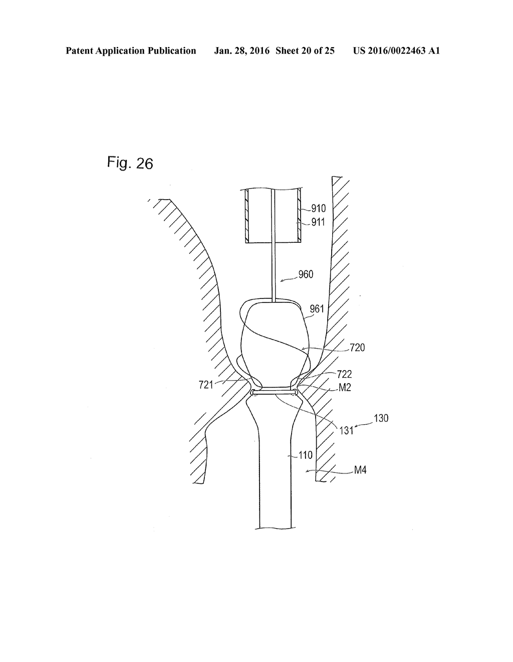 DIGESTIVE TRACT DEVICE - diagram, schematic, and image 21