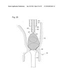 DIGESTIVE TRACT DEVICE diagram and image