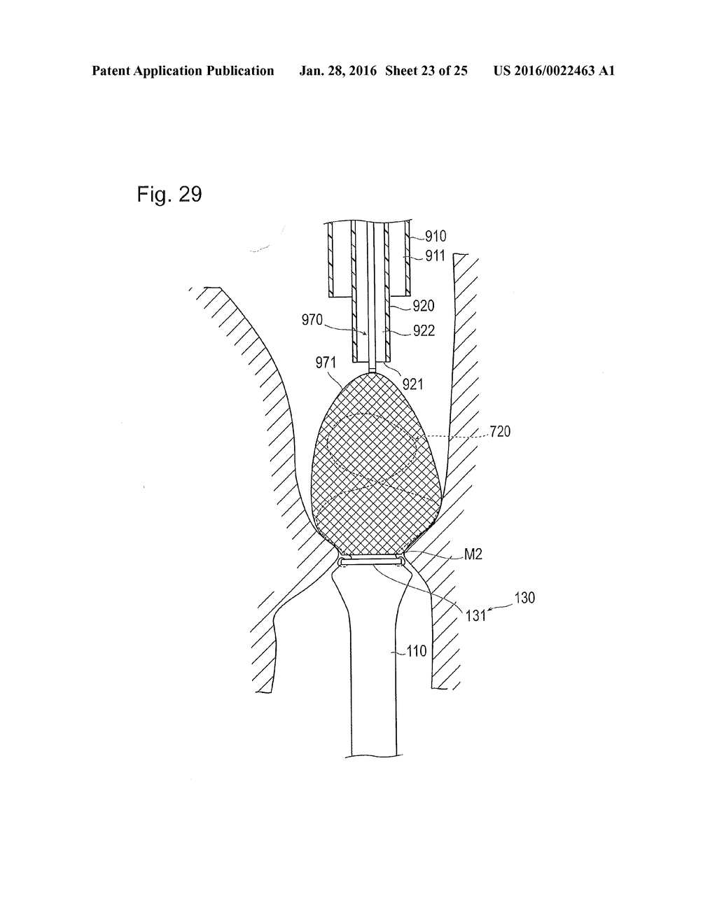 DIGESTIVE TRACT DEVICE - diagram, schematic, and image 24