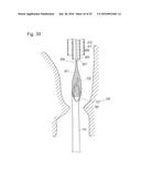 DIGESTIVE TRACT DEVICE diagram and image