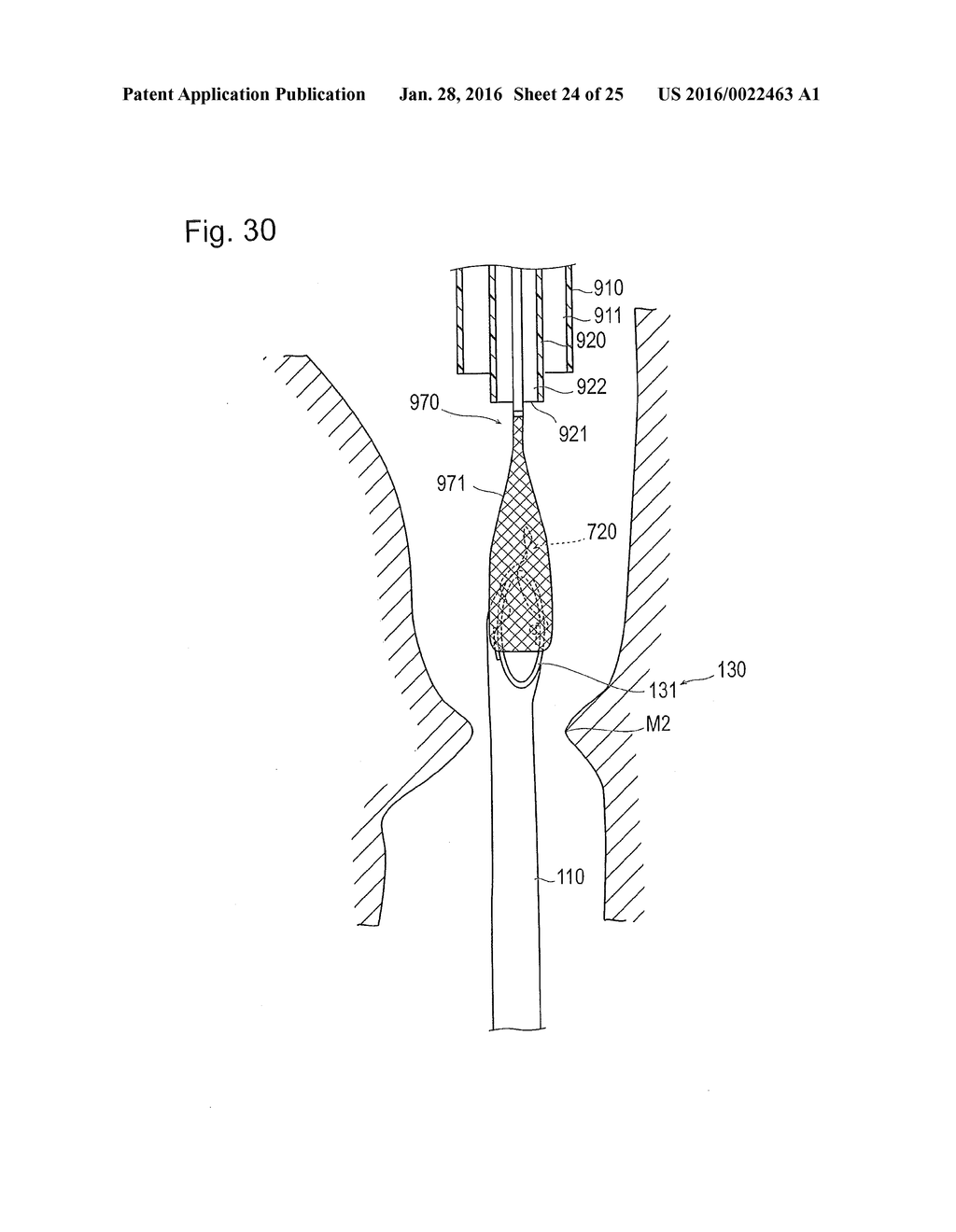 DIGESTIVE TRACT DEVICE - diagram, schematic, and image 25