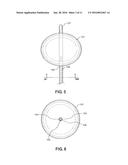 Balloon Immobilization Device for Radiation Treatment diagram and image