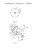 Balloon Immobilization Device for Radiation Treatment diagram and image