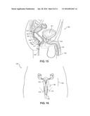 Balloon Immobilization Device for Radiation Treatment diagram and image