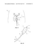 Balloon Immobilization Device for Radiation Treatment diagram and image