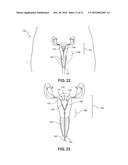 Balloon Immobilization Device for Radiation Treatment diagram and image