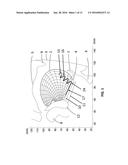 TONGUE DEFORMATION IMPLANT diagram and image