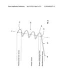 TONGUE DEFORMATION IMPLANT diagram and image