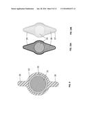 TONGUE DEFORMATION IMPLANT diagram and image