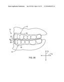 DENTAL APPLIANCE FOR TREATMENT OF SLEEP APNEA diagram and image