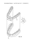 DENTAL APPLIANCE FOR TREATMENT OF SLEEP APNEA diagram and image