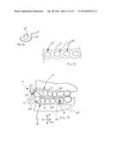 DENTAL APPLIANCE FOR TREATMENT OF SLEEP APNEA diagram and image