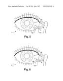 TREATMENT MEDIUM DELIVERY DEVICE AND METHODS FOR DELIVERY OF SUCH     TREATMENT MEDIUMS TO THE EYE USING SUCH DELIVERY DEVICE diagram and image