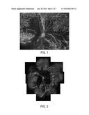 COMPOSTIONS AND METHODS FOR TREATING RETINAL DISEASE diagram and image