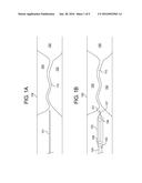 SUPPORTIVE BALLOON CATHETER diagram and image