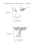 STIMULATION PATTERNS FOR TREATING DRY EYE diagram and image