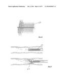 EMBOLISATION SYSTEMS diagram and image