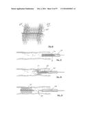 EMBOLISATION SYSTEMS diagram and image