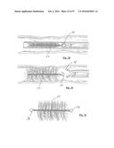 EMBOLISATION SYSTEMS diagram and image