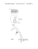 EMBOLISATION SYSTEMS diagram and image