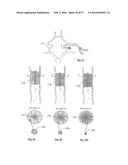 EMBOLISATION SYSTEMS diagram and image