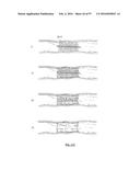 EMBOLISATION SYSTEMS diagram and image