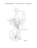 EMBOLISATION SYSTEMS diagram and image