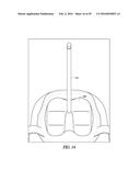 INSTRUMENTS AND METHODS IN PERFORMING KINEMATICALLY-ALIGNED TOTAL KNEE     ARTHROPLASTY diagram and image