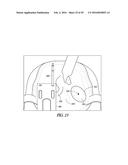 INSTRUMENTS AND METHODS IN PERFORMING KINEMATICALLY-ALIGNED TOTAL KNEE     ARTHROPLASTY diagram and image